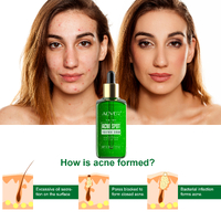 Aliver Safe Pimple Remover Acne Serum Treatment Tea Tree Clear Removal Face Blemish Spot Cleaner Comedone
